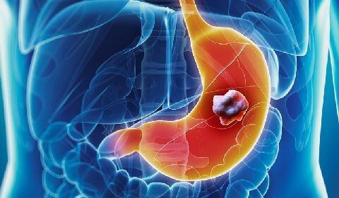 Nutrición enteral en pacientes con cáncer gastrointestinal complicado con diabetes mellitus